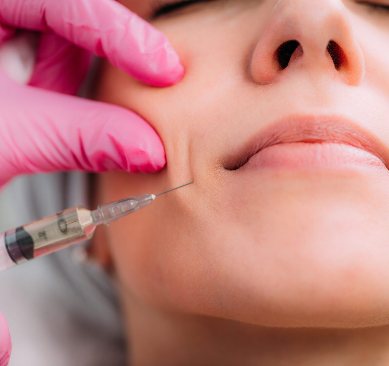 Get Flawless Skin with Restylane Dermal Fillers