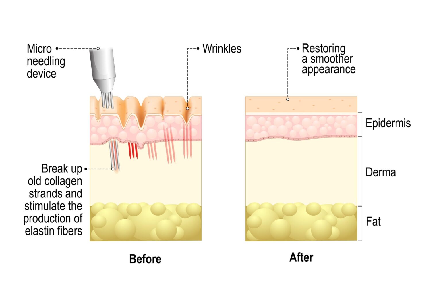 Genius RF Microneedling Face Scottsdale