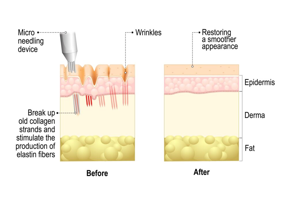 Genius RF Microneedling (Body) Scottsdale