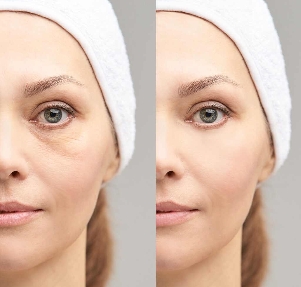 Genius RF Microneedling Under Eye with Growth Factors