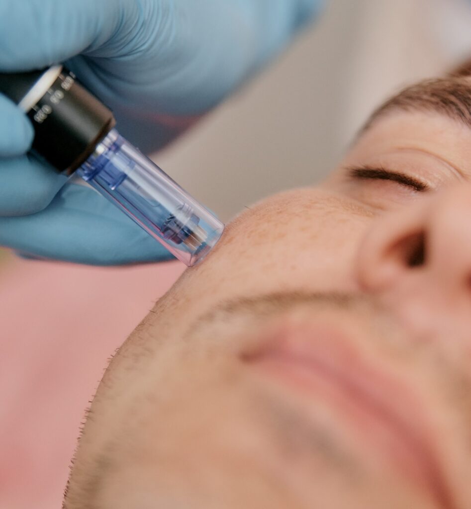 Genius RF Microneedling Face Scottsdale