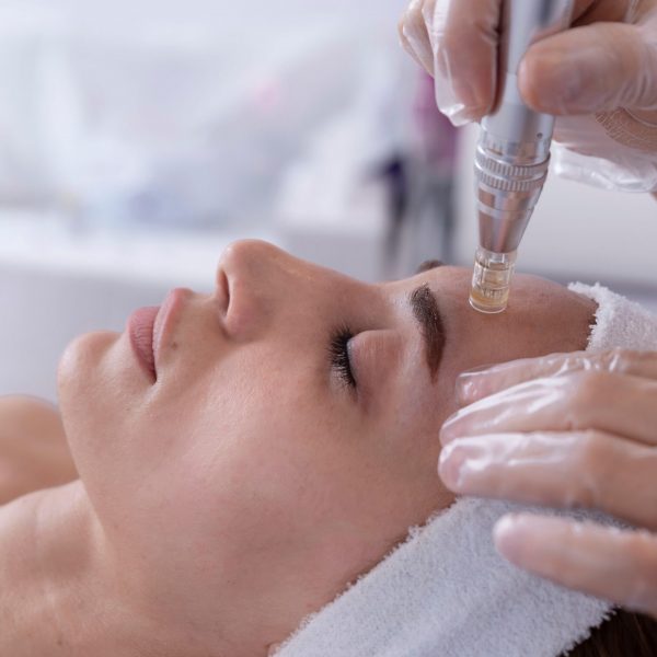 Genius RF Microneedling Face Scottsdale